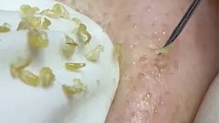 Big Cystic Acne Extraction Blackheads Milia Whiteheads Removal Pimple Popping Compilation 5 [upl. by Beore]