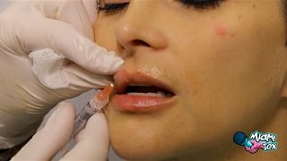 Botox amp Lip Fillers My Before and After GRL TOX [upl. by Alaikim]