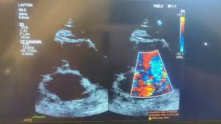 Patient presents to the clinic with chest pain and you see this short axis what do you suspect [upl. by Nila]