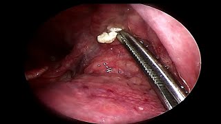 Removing LARGE Tonsil Stone  Doctor Anh [upl. by Darmit]