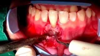 Endodontic surgery Apicoectomy and Retrofill by Dr Narong Laohapatcharinfacebookdrnarongdental [upl. by Ware110]