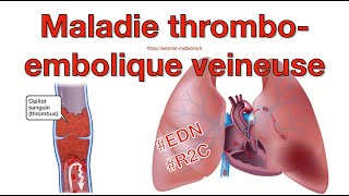 Thrombose veineuse profonde et embolie pulmonaire item 226  lessentiel à retenir pour lEDN [upl. by Gniw548]