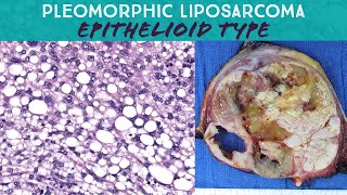 Pleomorphic liposarcoma epithelioid type Oregon Case 15 pathology sarcoma spindle cell neoplasm [upl. by Garlaand]