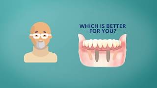 All on 4 Dental Implants Video Explainer  Why All on 4 [upl. by Ahsihat511]