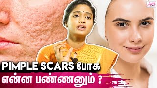 90  Pimples Scars ஆக மாற வாய்ப்பு இருக்கு  Skin Specialist Dr Archana  Acne Treatment Skin Care [upl. by Anirret849]