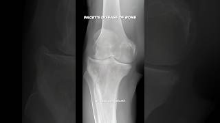 Knee Replacement for PAGET’S Disease of Bone shorts [upl. by Leizo82]