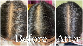 My Honest Hair loss Journey amp How I fixed it [upl. by Ysak27]