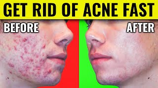 Say Goodbye to Acne Dr Bergs Proven Methods for Clearing Your Skin [upl. by Falk]