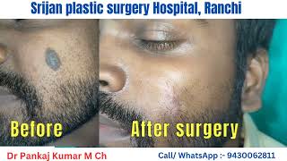 Birthmark Removal Birthmark Removal with surgery  laser treatment by Dr Pankaj Kumar [upl. by Eldwen]