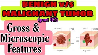 BENIGN vs MALIGNANT TUMOR on the basis of Gross amp Microscopic features  part 02 [upl. by Rebmat]