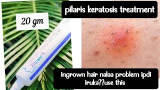 zitcare s salicylic acid gel review  pilaris keratosis treatment  acne [upl. by Nela461]