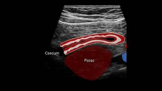 Appendicitis ultrasound ctisus [upl. by Cissy]