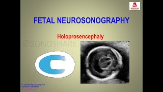 Fetal Neurosonography – Holoprosencephaly [upl. by Laughry660]