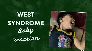 west syndrome seizure west syndrome kya hota hai in hindi west syndrome infantile spasms [upl. by Craddock645]