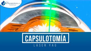 CAPSULOTOMÍA LÁSER YAG [upl. by Adnohsed798]