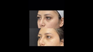 Under Eye Filler Treatment with PA Cathy  Ageless MD [upl. by Sille861]