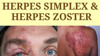 Herpes Simplex  Herpes Zoster skin skininfection herpesvirus herpeszoster herpessimplex [upl. by Alleuqahs]