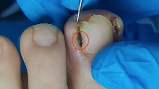 【Daily Pedicure Tutorial】Removing Deeply Embedded Ingrown Toenails on Both Sides of The Big Toe [upl. by Nahtnahoj]