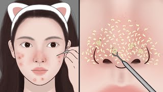 Satisfying Relaxation ASMR Blackhead Removal Blackhead extraction  Mengs Stop Motion [upl. by Leilamag873]