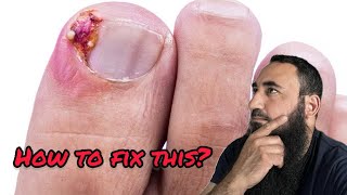 Best Nail Surgery  Partial Nail Avulsion PNA for Ingrown toe nail Great Results [upl. by Annovy]