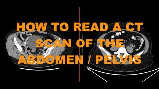 How to read a CT abdomen pelvis scan  introduction to abdominal imaging for junior doctors [upl. by Irehs]