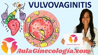 VULVOVAGINITIS Síntomas causas diagnóstico y tratamiento  Ginecología y Obstetricia [upl. by Enneirdna]