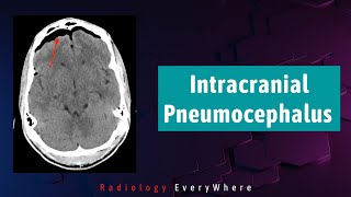 Pneumocephalus Causes  Radiology tutorials  Radiology Everywhere  1000 cases in 100days  video 4 [upl. by Addis]