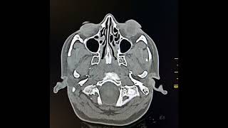 Otitis media and acute mastoiditis [upl. by Mcgraw]