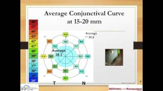 Fitting and Troubleshooting Scleral Lenses Part 1 [upl. by Boehike]