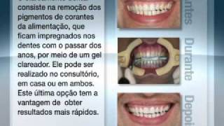 Clareamento dental em brasilia [upl. by Lidia]