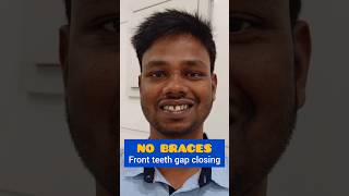 NO BRACES Front Teeth Gap Closure GapAligner Dr Srishti Bhatia smilemakeover [upl. by Coray]