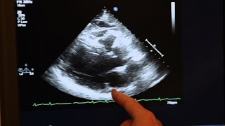 Echocardiogram Demonstration [upl. by Vergos]