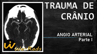 Trauma Craniano  Angio Arterial parte I [upl. by Aibsel]