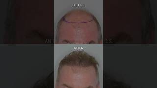 Restoring the frontal forelock  Anthony Bared MD FACS  Miami FL [upl. by Slayton]