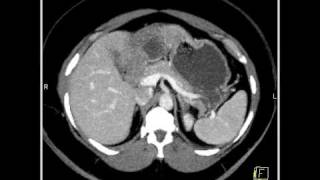 Abdomen Liver Hemangioma of the Liver8 of 8 [upl. by Nylesaj]