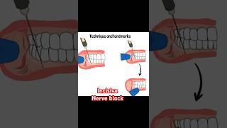 Incisive nerve block [upl. by Reisfield]