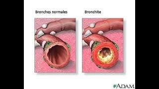 Traitement naturel de la bronchite [upl. by Ahtel196]