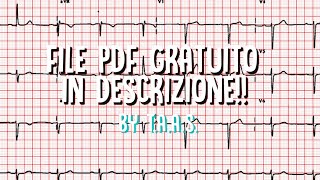 Il blocco atrioventricolare completo in 1 minuto file PDF in descrizione [upl. by Mckenna]
