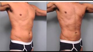 The Benefits of Liposuction for Men  Dr Sterry Explains [upl. by Kalinda]