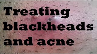 Understanding Blackheads and Acne Treatment [upl. by Wearing595]