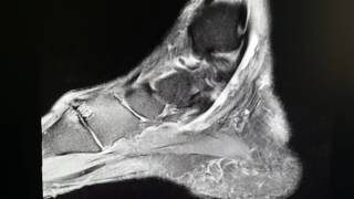 Flexor Hallucis Longus Tendon Rupture as seen on MRI [upl. by Keviv]