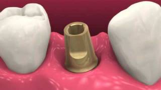 Restoring dental implants video BioHorizons [upl. by Nrubua]