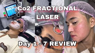 CO2 Fractional Laser Review DAY 1  7 [upl. by Simmonds]