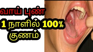 Vai pun mouth ulcer [upl. by Seta]