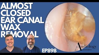 ALMOST CLOSED EAR CANAL WAX REMOVAL  EP898 [upl. by Sulecram598]