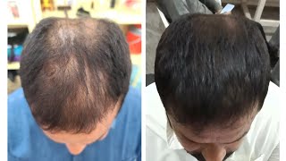 Hair regrowth treatment by Dr Danish Chauhan hairregrowth [upl. by Llenra316]