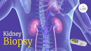 How is Kidney Biopsy Done  Kidney Biopsy Procedure  CARE Hospitals [upl. by Sille]