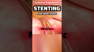 Coronary Angioplasty OR Coronary Stenting angioplasty coronaryheartdisease [upl. by Jerrold]