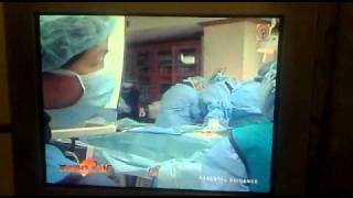 1st Percutaneous Closure of PFO part 4 of 5 [upl. by Yklam919]