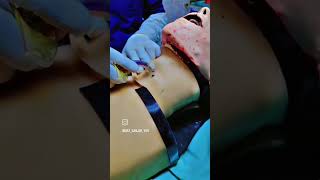 Tracheostomy procedure 🏥🩺🎉 chatalternative textonly [upl. by Toddie]